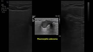 Parotid gland mass 1 imaging ultrasound radiology salivaryglands cases [upl. by Mimajneb963]