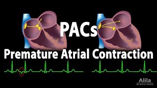 Premature Atrial Contractions PACs Animation [upl. by Eenaffit]