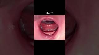 Tongue Tie Release  Healing Time Lapse [upl. by Angelica]