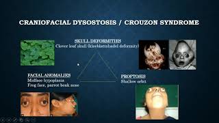 Brief discussion on Crouzon syndrome [upl. by Brannon]