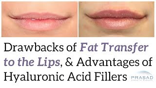 Why Lip Augmentation is More Predictable and Heals Faster with Cosmetic Fillers Over Fat Grafting [upl. by Hetti]