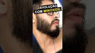 RESULTADO COM MINOXIDIL impressionante barba minoxidil [upl. by Cattan]