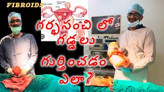 గర్భసంచి లో గడ్డలు వాటి లక్షణాలుdrkranthigynecologist uterine fibroids [upl. by Roque]