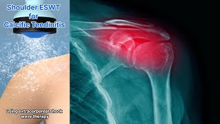 Calcific Tendinitis Of The Shoulder Extracorporeal Shock Wave Therapy May Be The Solution [upl. by Humberto]