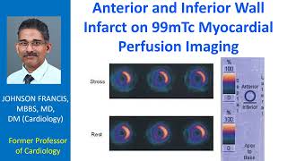 Anterior and inferior wall infarct on 99mTc myocardial perfusion imaging [upl. by Ydner]