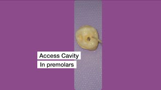 Access Cavity Preparation in Premolar [upl. by Rratsal]