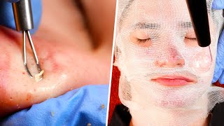 Acne Facial  Blackhead Extractions [upl. by Dnomyad]