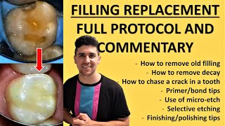 Old Fillings And Decay Near A Crack Class II Resin Filling Replacement  Fillings Case 1 [upl. by Ettolrahc]