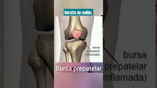 Bursa prepatelar de rodilla bursitis de rodilla [upl. by Mariejeanne]