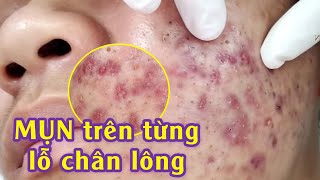 Điều trị mụn viêm mụn bọc hiệu quả tại TPHCM  Inflammatory Acne  Minh Khôi Hiền Vân Spa 582 [upl. by Bolan432]