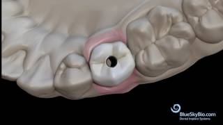 Screw Retained Crown Laboratory Bonding [upl. by Topper]