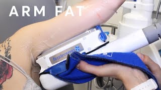 How to reduce arm fat  Fat Freezing [upl. by Nuriel]