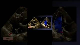 Mitral Annular Disjunction MAD [upl. by Fairley]