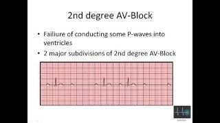 ECG cardiac arrhythmias [upl. by Hsac]