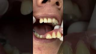 Flexible dental prosthesis without palate mrdent dentalclinic smile dentist viral [upl. by Mikah]