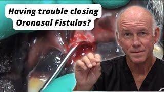 Having trouble closing Oronasal Fistulas [upl. by Ruella]