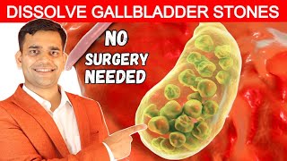 No Surgery Needed  Dissolve Gallbladder Stone  Dr Vivek Joshi [upl. by Koss326]