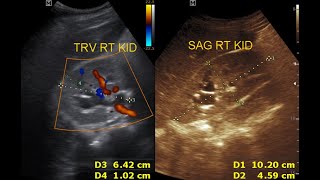 Ultrasound cases 200 of 2000  Chronic pyelonephritis [upl. by Azenav141]