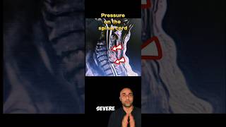 Cervical Myelopathy explained neckpain spine surgeon cervical awareness cervicalpain shorts [upl. by Sayed]