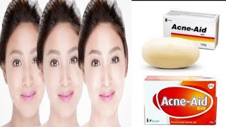 Acne  Aid Soap  Best medicated soap foroily and acne skin [upl. by Seely]