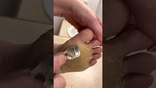 Feet Shaving Ball of Foot  Jan 12 2023  Diffuse Epidermolytic Palmoplantar Keratoderma [upl. by Yurik754]