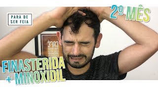 Finasterida e Minoxidil  2 meses  Primeiros Resultados  PARA DE SER FEIA [upl. by Holden]