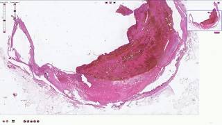 Atheromatous Plaque with Thrombosis  Histopathology [upl. by Eiramenna800]