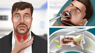 ASMR Animation Help MrBeast remove fish bones stuck in his throat [upl. by Oba]