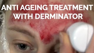 DermarollerDerma needling Demo with Derminator [upl. by Tirrell]