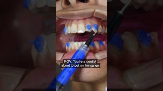 Invisalign attachments [upl. by Deva]