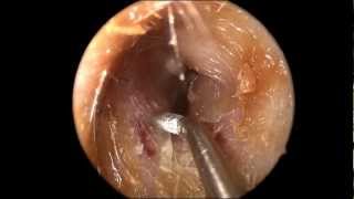 Ear Wax Cerumen Removal in HD [upl. by Nagah]