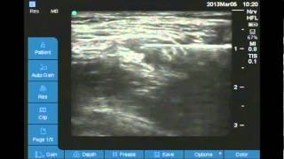 Ultrasound Guided Femoral nerve block [upl. by Maryn]