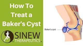 How To Treat a Baker’s Cyst and Speed Recovery [upl. by Urana]