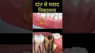 Dental abscess  Pus discharge from gum  Dr Lahna Singh teeth toothdecay [upl. by Yug753]