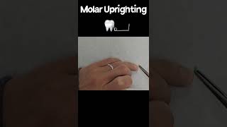 Molar uprighting wire system molaruprighting wirebending drsung [upl. by Romeon]