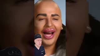 Extreme Filler Injections  Plastic Surgeon Reacts [upl. by Lleder334]