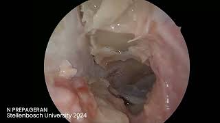 Module 4 Orbital Optic Nerve Decompression Intraconal Dissection [upl. by Trude]