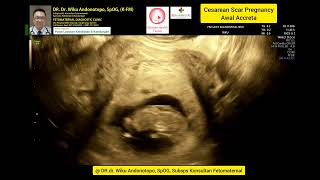 Awal Accreta Cesarean Scar Pregnancy 10 weeks [upl. by Iva]