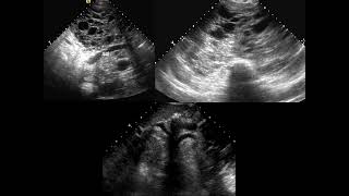 Chest FRCR2b CASES [upl. by Arded788]