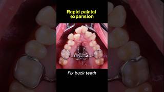 Expand upper teeth with rapid palatal expander braces orthodontist dentist [upl. by Russom]