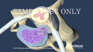 Cervical Disc Herniation [upl. by Brittney]