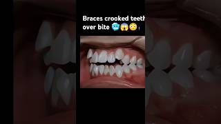 Braces crooked teeth over bite braces orthodontist dentist [upl. by Antonie]