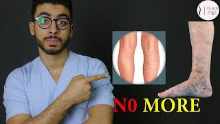 ما هى دوالى الساقين ؟  علاج مشكلة الدوالى نهائيا varicose veins treatment [upl. by Viscardi425]