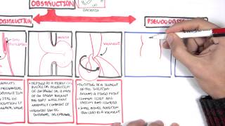 Bowel Obstruction  Causes and Pathophysiology [upl. by Anirad354]