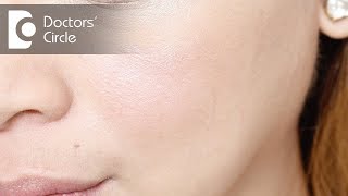 How to remove white spots on face  Dr Rashmi Ravindra [upl. by Aek]