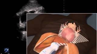 3D How To Subxiphoid View Echocardiography  SonoSite Ultrasound [upl. by Mackie]