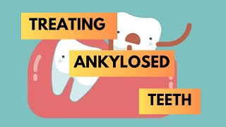 Management of Ankylosed Teeth  Orthodontics [upl. by Maiocco]