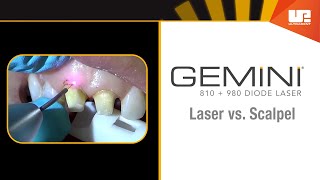 Gemini Clinical – Gingivectomy [upl. by O'Dell]