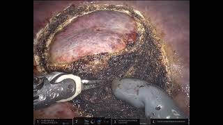 Robotic Microwave Ablation  Partial hepatectomy [upl. by Leyameg]