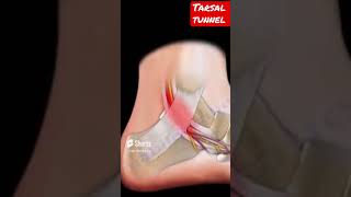 Tarsal tunnel syndrome shorts [upl. by Giraldo]